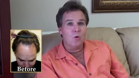 Dr. Brett Bolton | Fantastic Hair Transplant Results