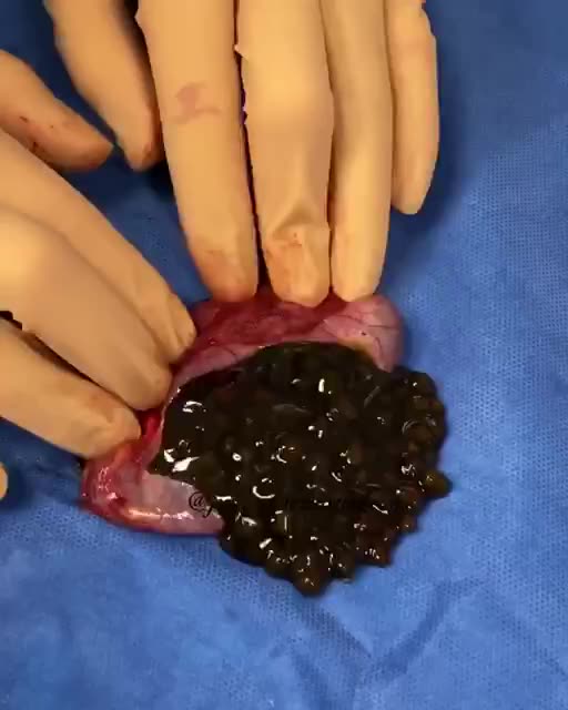 Have you ever seen a gallbladder cut open and gallstones taken out?