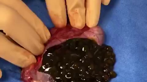 Have you ever seen a gallbladder cut open and gallstones taken out?
