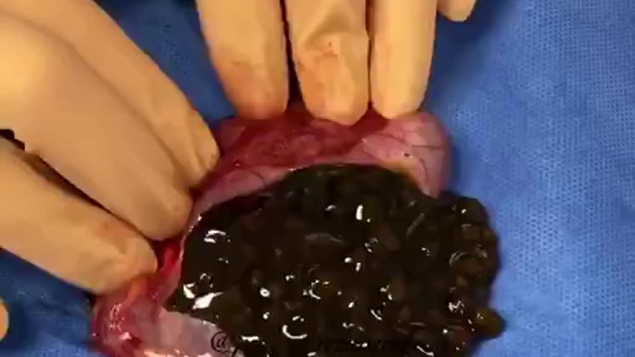 Have you ever seen a gallbladder cut open and gallstones taken out?