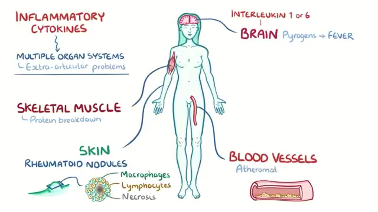 Rheumatoid arthritis - causes, symptoms, diagnosis, treatment, pathology