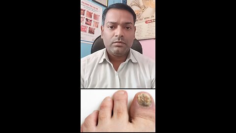 नाखूनों के फंगल इन्फेक्शन का इलाज ।