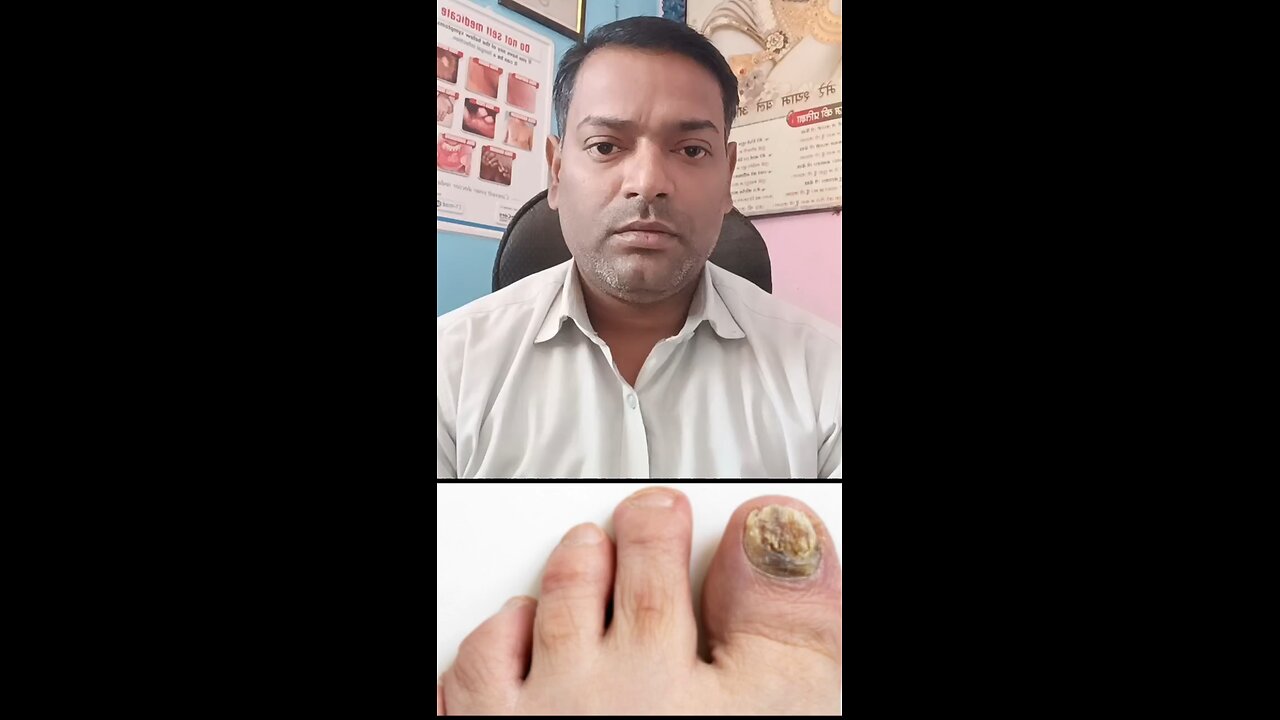 नाखूनों के फंगल इन्फेक्शन का इलाज ।