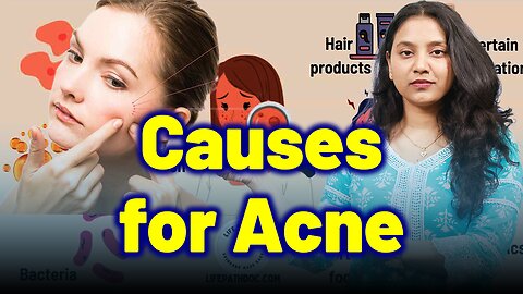 Causes for Acne, Pimples ,Blackheads . |Treatment Cure Relief Medicine | Homeopathy