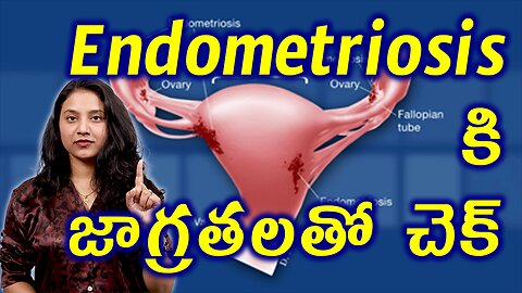 ఎండోమెట్రియోసిస్ కి జాగ్రతలతో చెక్ Precautions for Endometriosis Treatment Cure Medicine హోమియోపతి