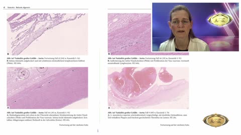 Turbo Cancer and Death after COVID Injections - Dr. Ute Krueger (MD)