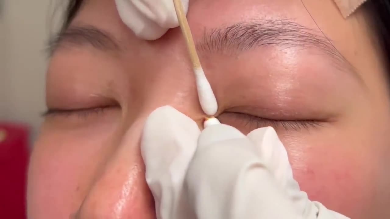 A Light Milia in the Eye