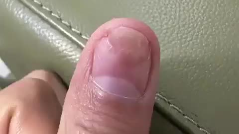 🤯✨ Watch Fingernail Regrow After Bruise! | FeedMyCuriosity