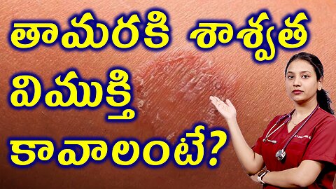 తామరకి శాశ్వత విముక్తి కావాలంటే? Best Homeopahty Treatment For Tinea or Ringworm Solution Medicine