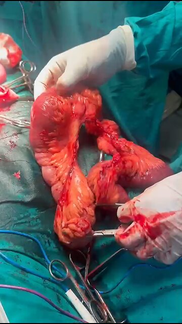 An operation had to be performed due to opium accumulation in the stomach. #operation #doctor #medi