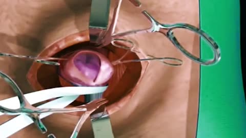 Inguinal Hernia Repair Surgery (3D Animation)