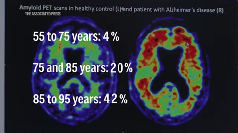 New study finds higher lifetime risk of eventually developing dementia