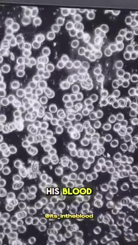 Unvaccinated blood before & after detox is both fascinating & scary