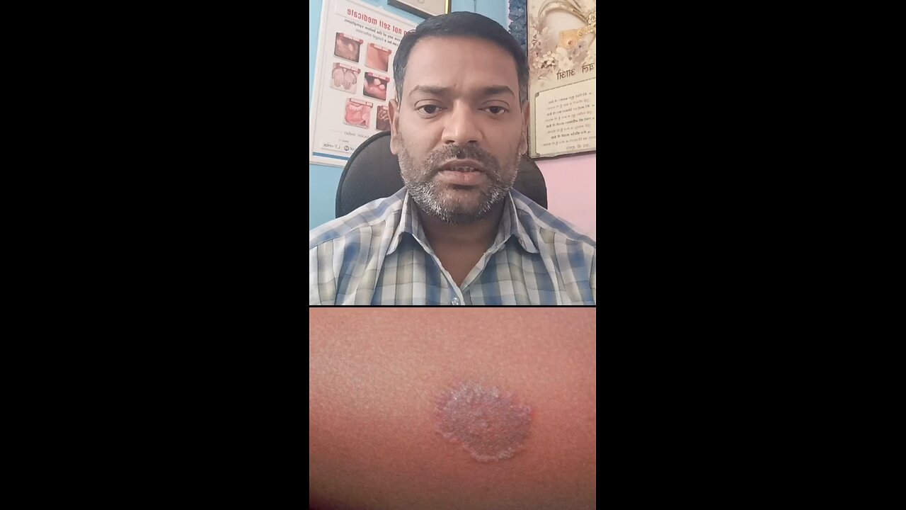 दाद का इलाज ।