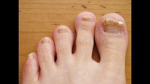 How to Get Rid of Toe Nail Fungus