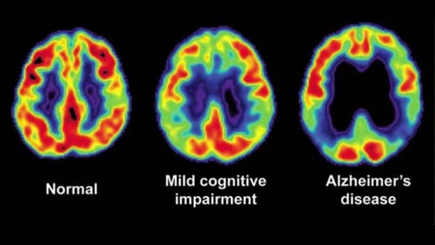 DEMENTIA & The WHOLE ORANGE Benefits