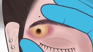 Breaking: ASMR Infected Eyebrow piercing removal#asmr #animation #viral #trendin