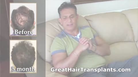 MaxHarvest™ Hair Transplant in Boise, Idaho by Dr. Brett Bolton – Promo