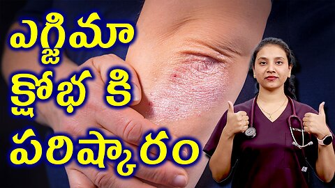 ఎగ్జిమా క్షోభకి పరిష్కారం Best Homeopathy Treatment Solution For Eczema, Ring Warm | హోమియోపతి