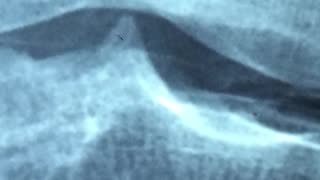 Dr. Linda Carney on Why We Really Lose Calcium #Shorts #DrLindaCarney