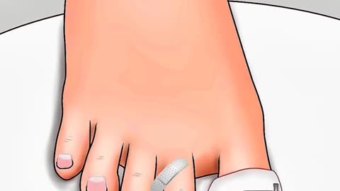 This Is How Doctors Fix a Painful Ingrown Toenail with Surgery!
