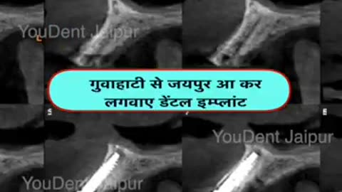 Best Dental Implant in India