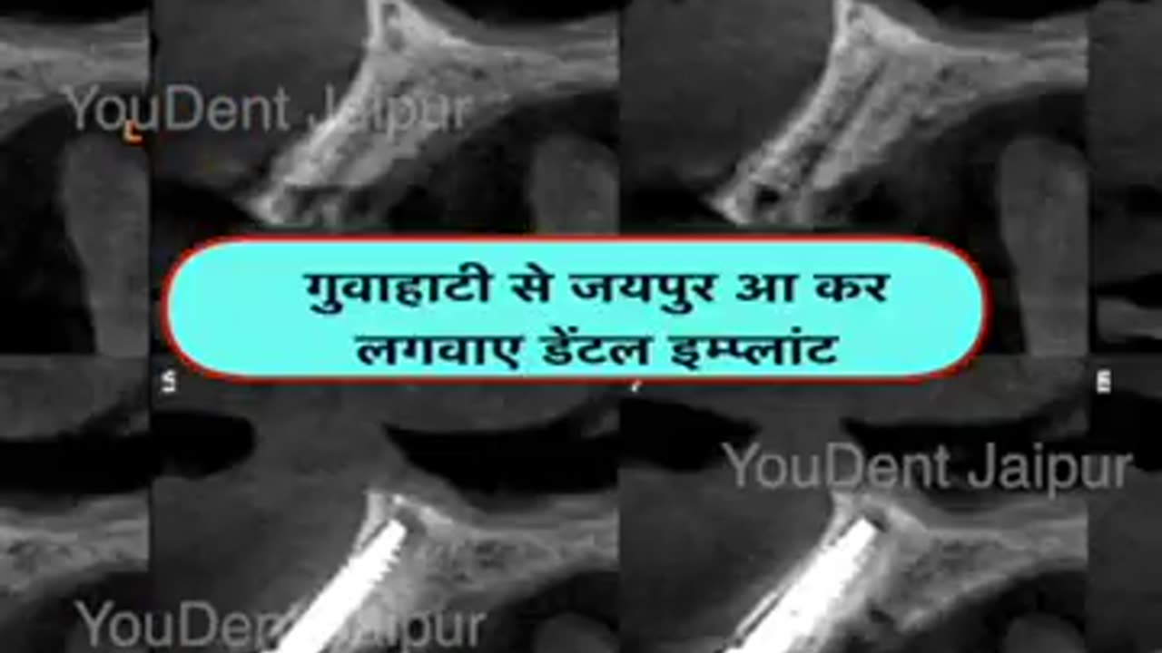 Best Dental Implant in India