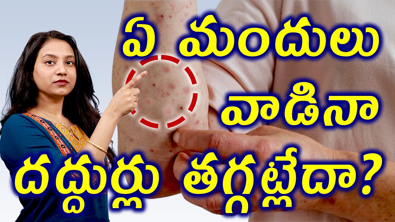 ఏ మందులు వాడినా దద్దుర్లు తగ్గడం లేదా? Best Homeopathy Treatment for Urticaria | హోమియోపతి