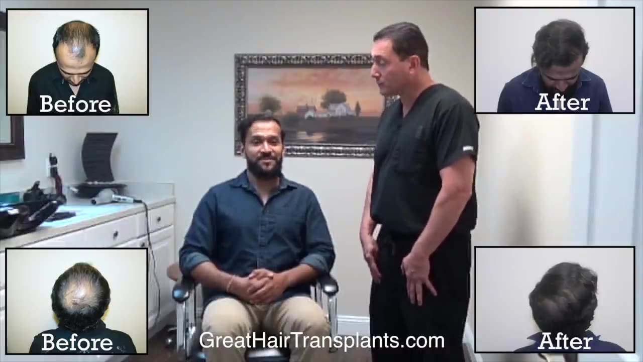 MaxHarvest™ Plus Hair Transplant for Patient Sanjay from Toronto