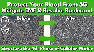 How To Protect Your Blood From 5G, Mitigate EMFs & Resolve Rouleaux?