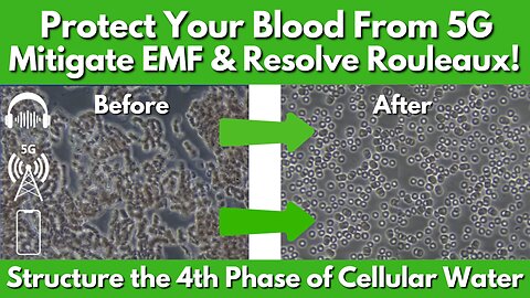 How To Protect Your Blood From 5G, Mitigate EMFs & Resolve Rouleaux?