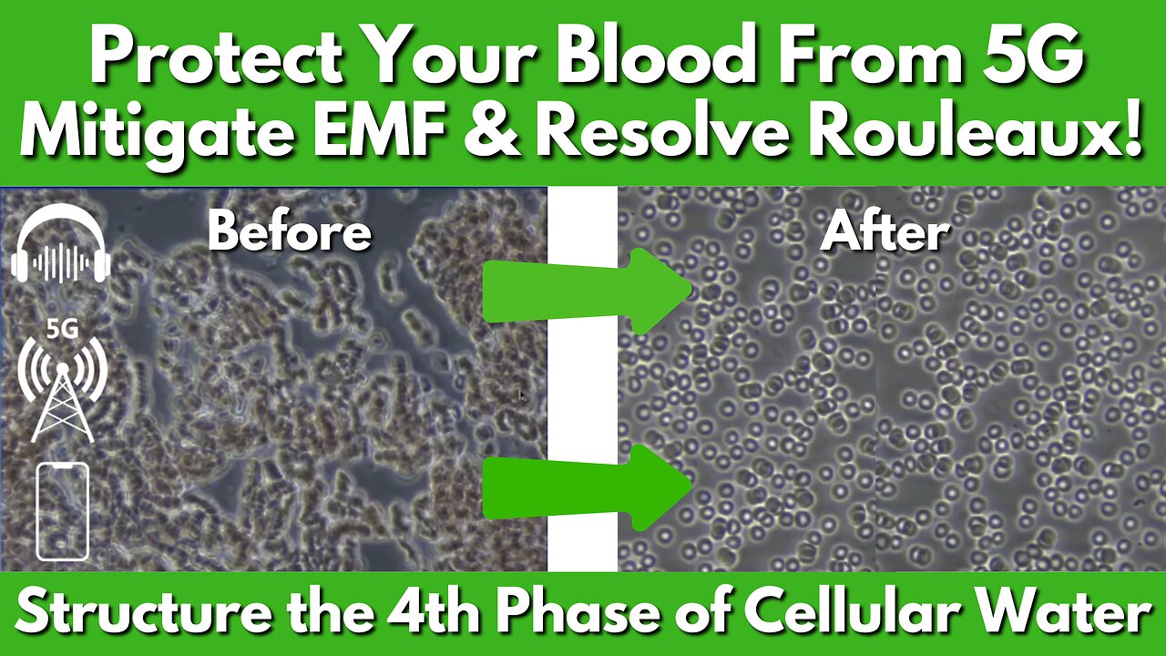 How To Protect Your Blood From 5G, Mitigate EMFs & Resolve Rouleaux?