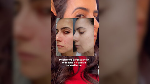 I Wish More Parents Knew That Acne Isn't A Skin Related Issue