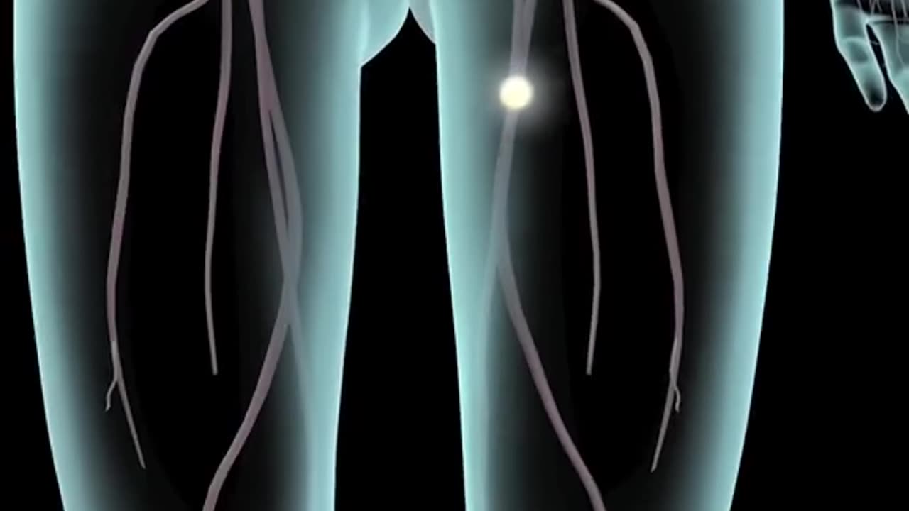 Deep Vein Thrombosis 3D Animation