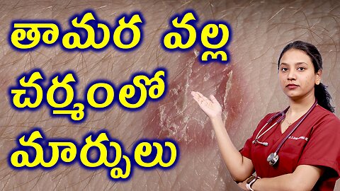 తామర వల్ల చర్మంలో మార్పులు Changes in the Skin Due to Tinea or Ringworm Homeopathy Treatment Cure