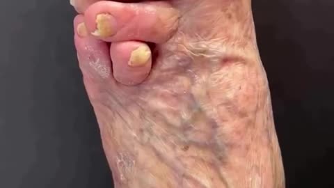 Clubbed Foot