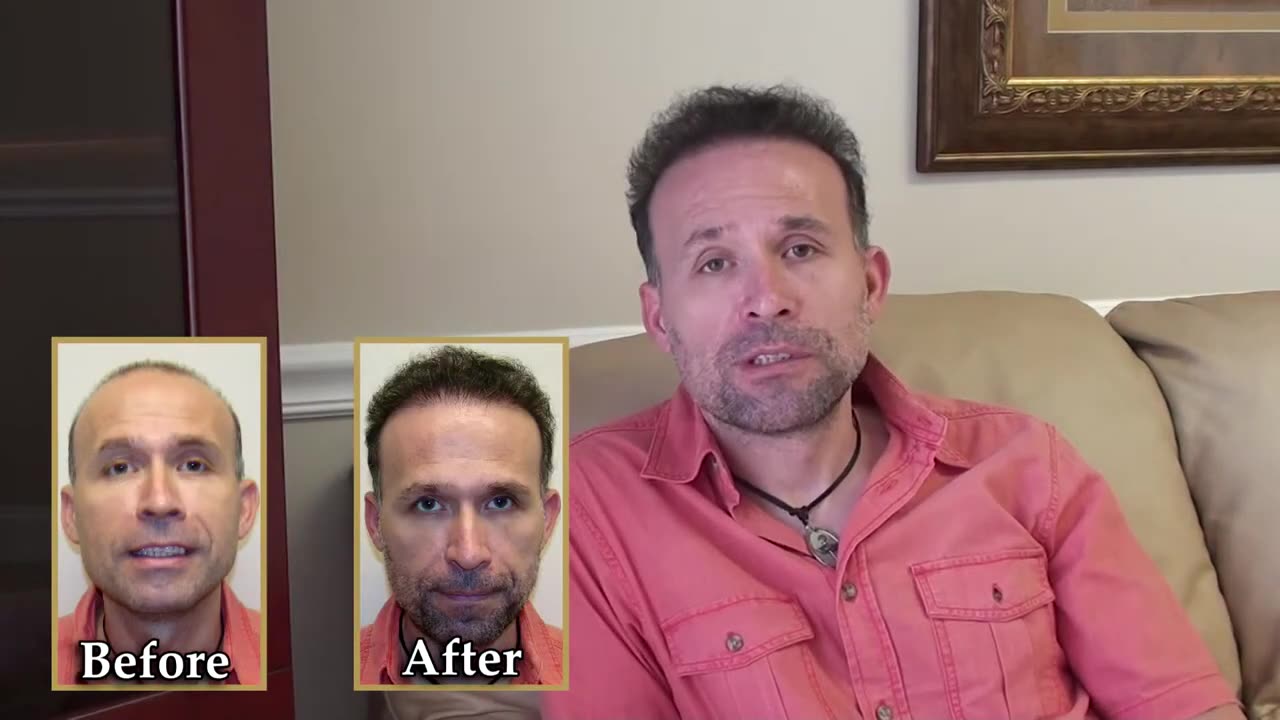 Dr. Brett Bolton Hair Restoration Results | Incredible MaxHarvest™ Transformation
