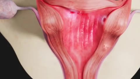 Hysteroscopy Procedure (3D Animation)