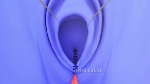 Vaginal Rejuvenation Procedure (3D Animation)