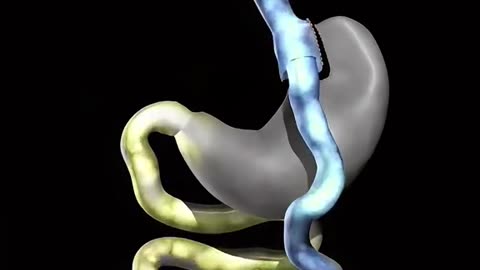 Gastric Bypass Surgery (3D Animation)