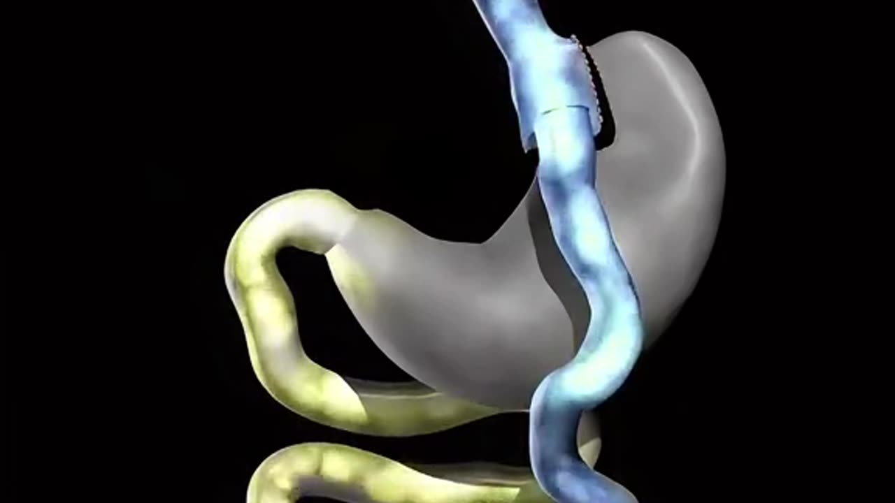 Gastric Bypass Surgery (3D Animation)
