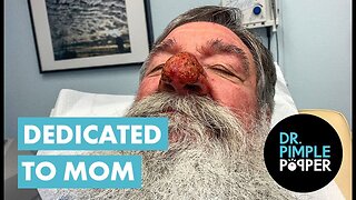 Rhinophyma Repair Dedicated to MOM
