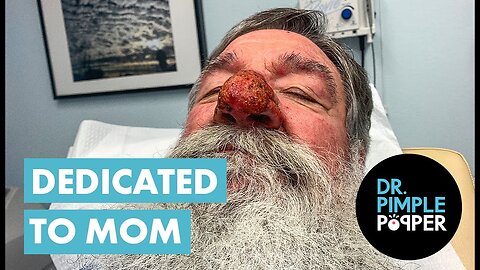 Rhinophyma Repair Dedicated to MOM