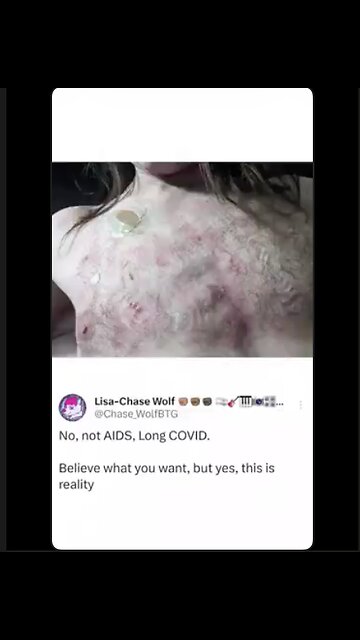 No dummy. You have Vaids from all the shots and boosters. NOT LONG COVID.