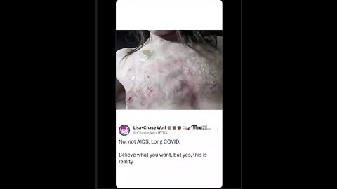 No dummy. You have Vaids from all the shots and boosters. NOT LONG COVID.