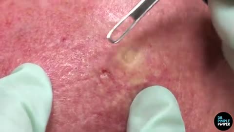 A Forehead of Blackhead Extractions Dr Pimple Popper Mines a Patient s Head