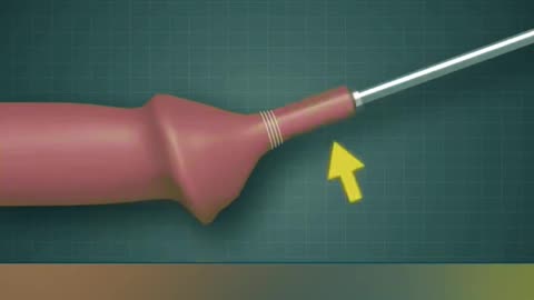 Circumcision Surgery 3D Medical Animation