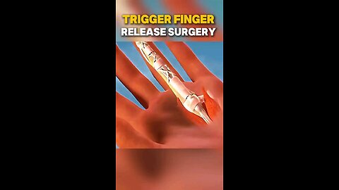 TRIGGERE FINGER