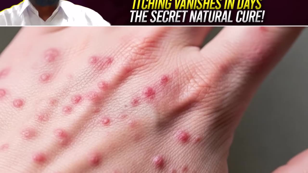 Treatment of itching within few hrs