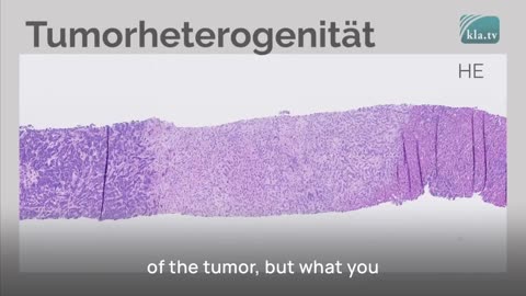 Dr. Ute Krüger on Tumor Correlation After Vaccinations